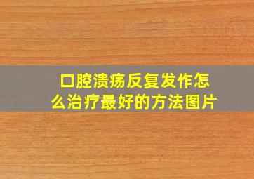 口腔溃疡反复发作怎么治疗最好的方法图片